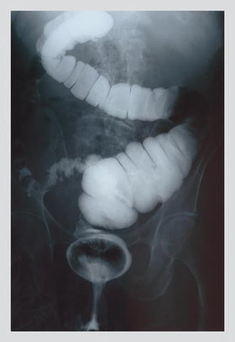 Intestine Barium 20x30 poster